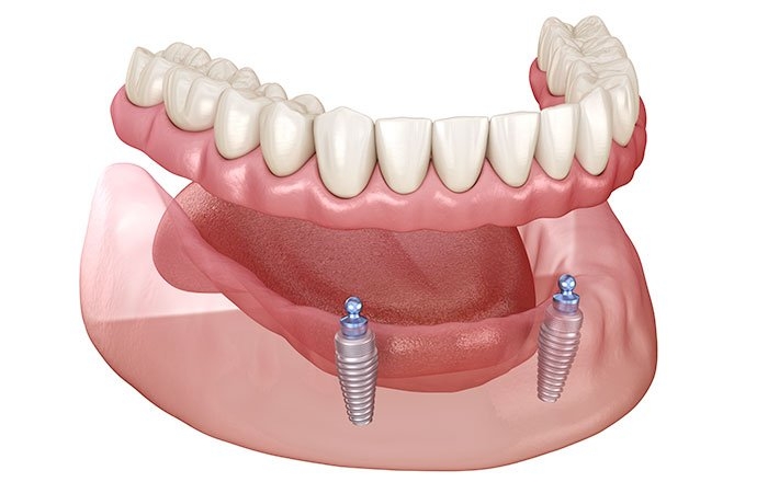 インプラントロケーター