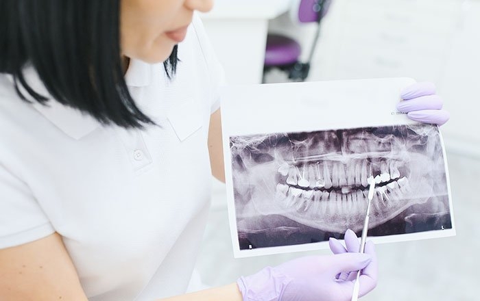 インプラント治療を進めるうえで大切な要素の一つに、インプラント体をしっかりと支えるための十分な骨の量が挙げられます。