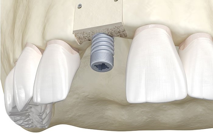 ベニアグラフトの流れ