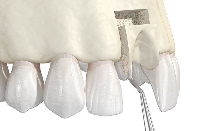 べニアグラフトは骨の減少が大きく広範囲な場合に行われる