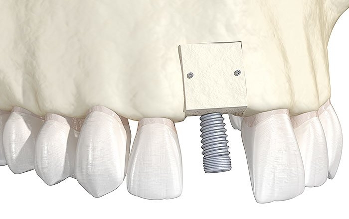 ベニアグラフトとは？