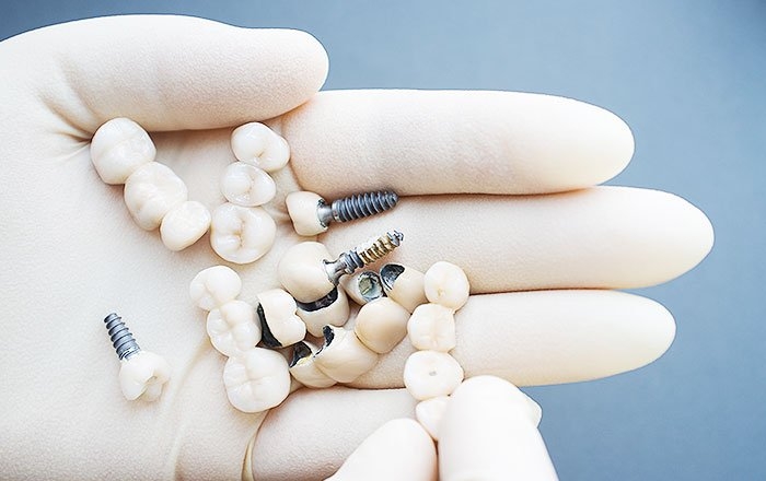 使用しているインプラントメーカーと製品情報を把握しておく