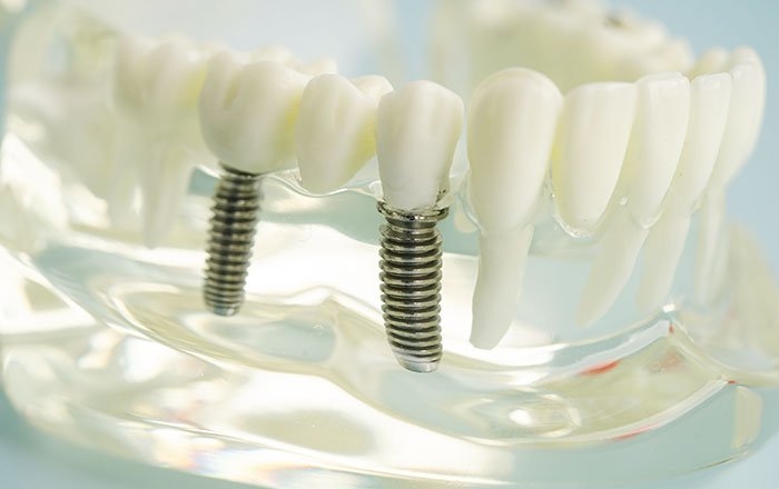 インプラントによる神経損傷の症状と治療法について