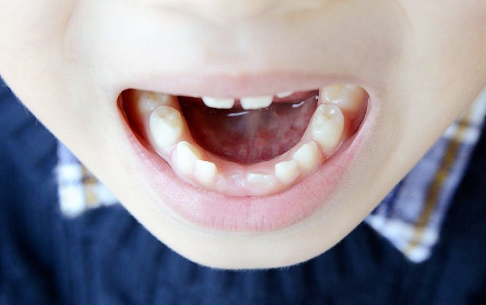 永久歯を失ったままにすると起こりうること：歯並びと噛み合わせが悪くなる