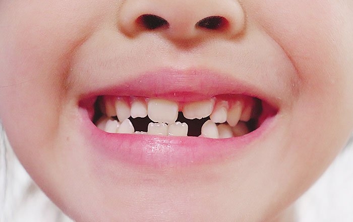 永久歯を失ったままにすると起こりうること：発音が悪くなる