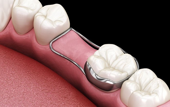 子供が永久歯を失った場合の治療法：保隙装置（ほげきそうち）