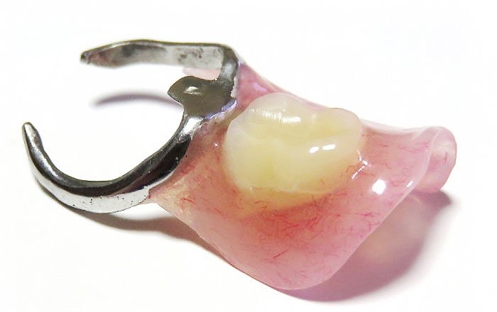 子供が永久歯を失った場合の治療法：小児義歯（入れ歯）