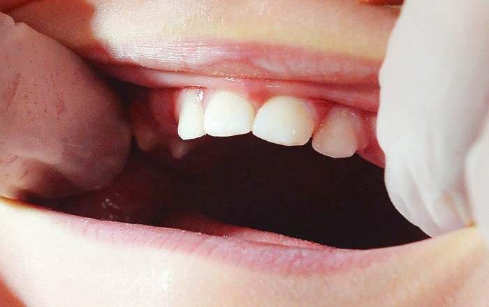 子供のインプラント治療が行えない理由：歯並びが変化するため