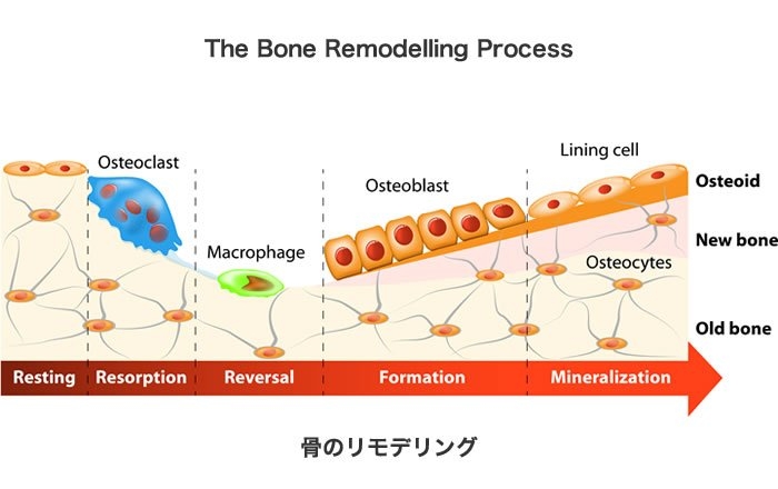 インプラント治療にエムドゲインを使うメリット：骨を増やせる