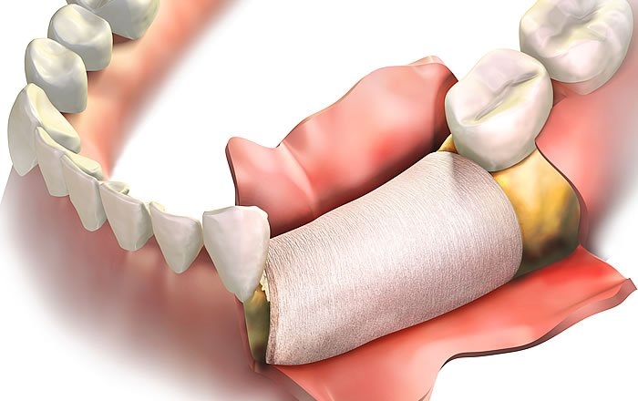 インプラント治療にエムドゲインを用いると得られる効果：GBR（骨誘導再生法）の作用を促進する