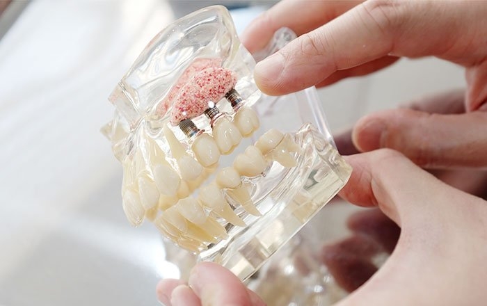 インプラント治療にエムドゲインを用いると得られる効果：抜歯後の骨を再生させる