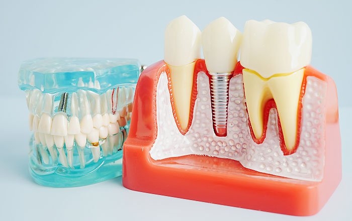 世紀で見る 続・インプラントの歴史