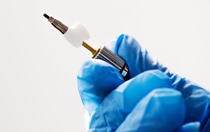 災害時に起こりうるインプラントトラブル：上部構造（被せ物）の破損・脱落