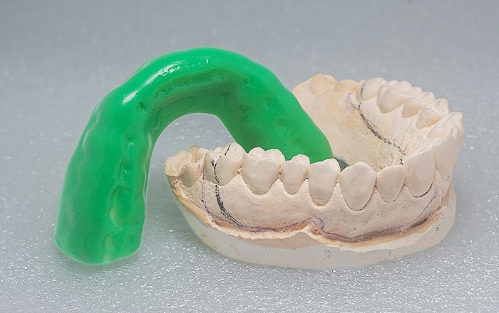 インプラントと競技生活を両立させる3つのポイント：マウスガードを使う