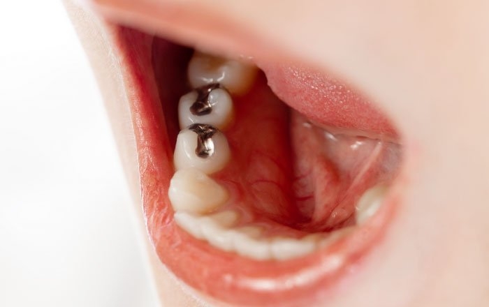 インプラント後に違和感が出る理由：ガルバニー電流の発生