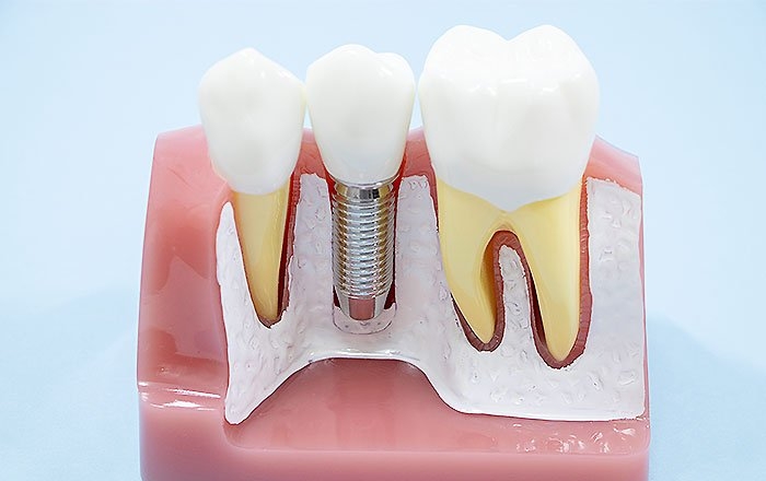インプラントを埋め込む顎の骨の中に味蕾はありません