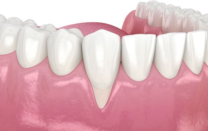 インプラント治療後に知覚過敏はなぜ起こる？：歯肉退縮