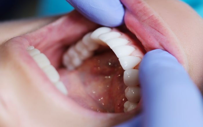 噛み合わせが原因の場合：被せ物（上部構造）の形や高さを調整し、歯に負担がかからないようにバランスを整えます。