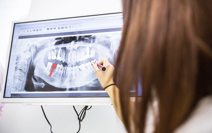 インプラントの埋入位置自体に問題がある場合：インプラントの上部構造を作り直して再装着したり、場合によってはインプラントの再手術を検討する