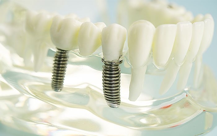 インプラントが嚥下に「間接的に」影響するのは？：合わない噛み合わせによる咀嚼不良