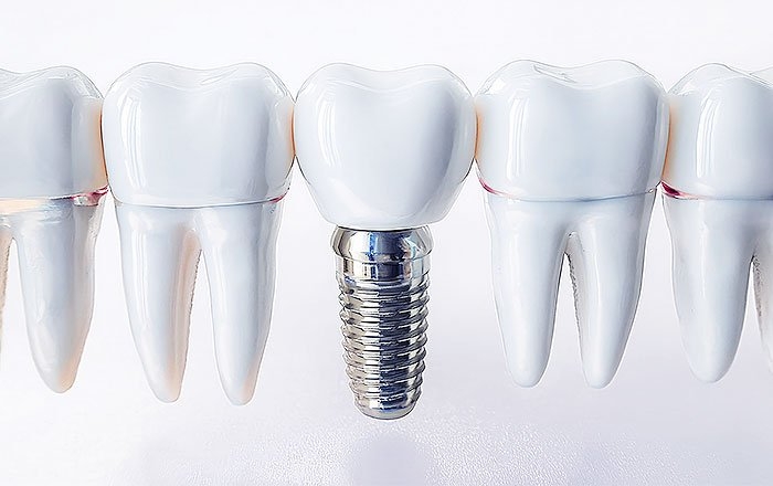 インプラント治療の相場