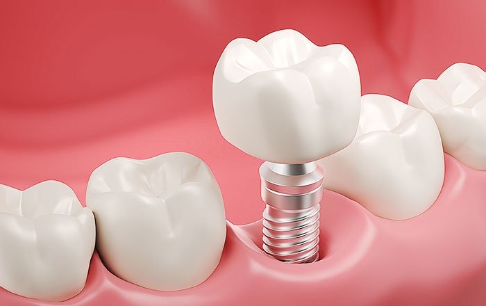 インプラント治療の内容による費用の差：上部構造の違い