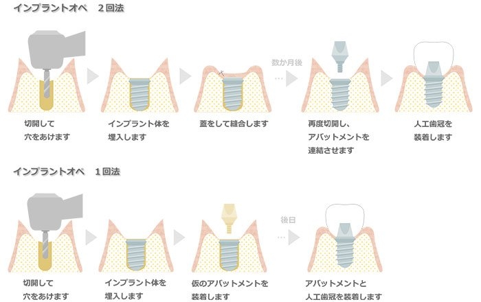 インプラント治療の内容による費用の差：術式の違い