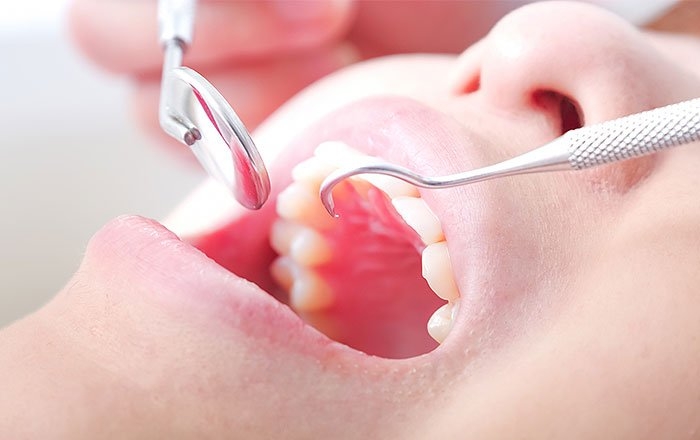 ドライマウス（口腔乾燥症）によるインプラントへの影響を緩和する方法：メンテナンスをしっかり受ける