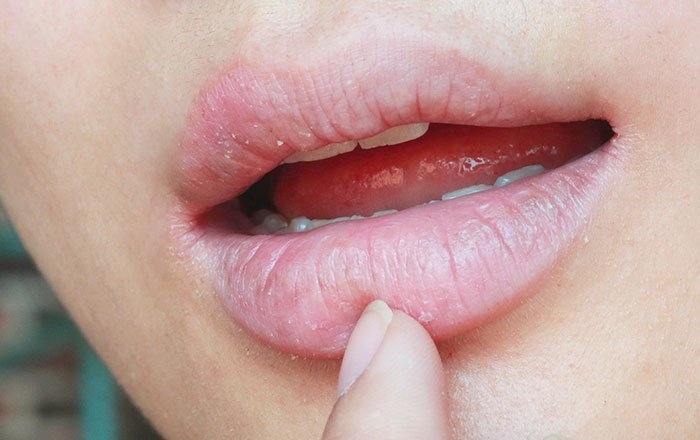 インプラントとドライマウス（口腔乾燥症）の関係