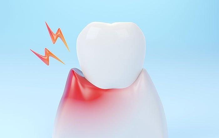 インプラントの麻酔が効きにくい4つの原因：強い炎症を起こしている