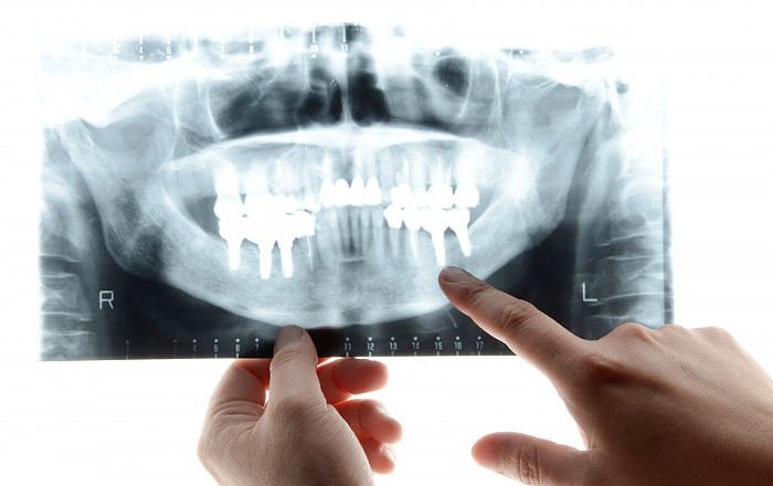 インプラントの麻酔が効きにくい4つの原因：骨の硬さや厚み