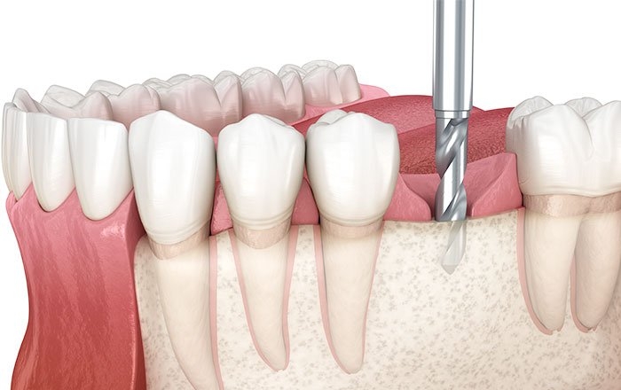 インプラント体（フィクスチャー）が外れてしまう原因：オーバーヒート