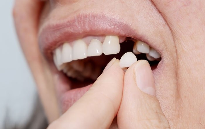 インプラントがうまく接合しない、外れてしまう…そんなお悩みをお持ちの方へ