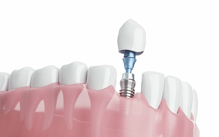 抜けた歯があり、見た目も気になる場合、優先度が高いのはインプラント治療