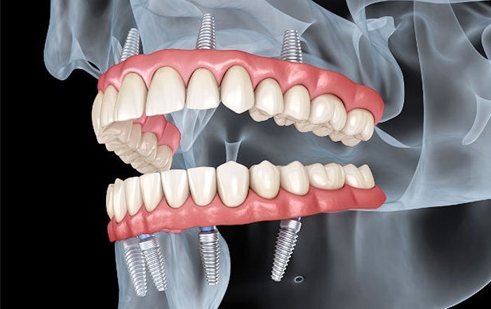 ほとんどの歯がない、または総入れ歯が合わずに悩んでいるなら、オールオン4やインプラントオーバーデンチャー