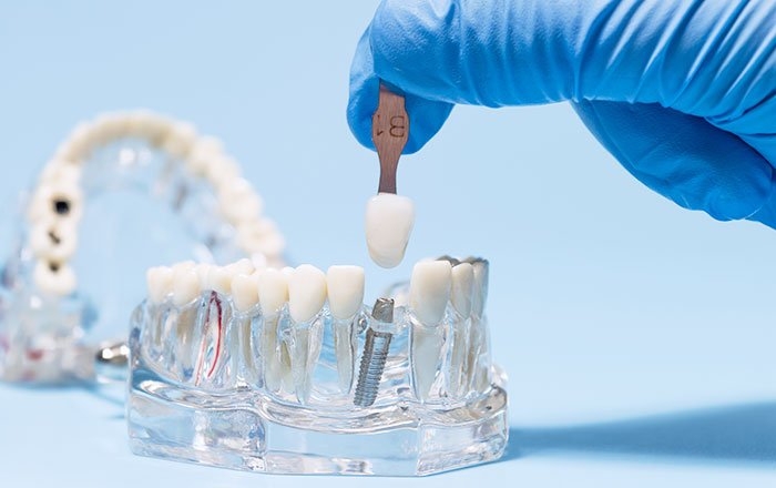 インプラントは噛み合わせ治療？審美治療？目的・違い・治療の順番について詳しく解説