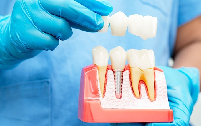 メジャーなインプラントメーカーを選ぶときの注意点