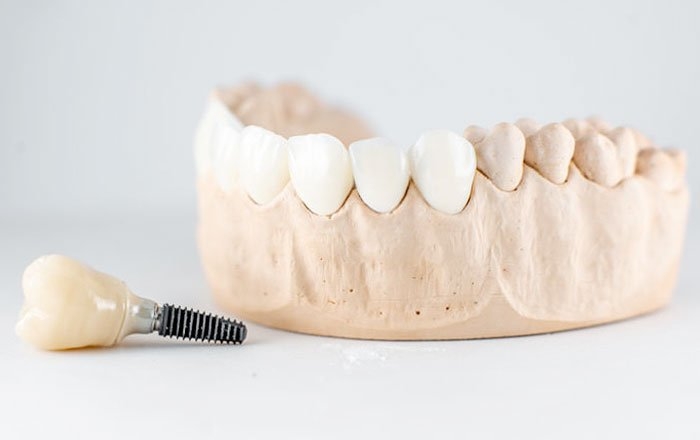 高齢になったらインプラントは外した方が良いのか