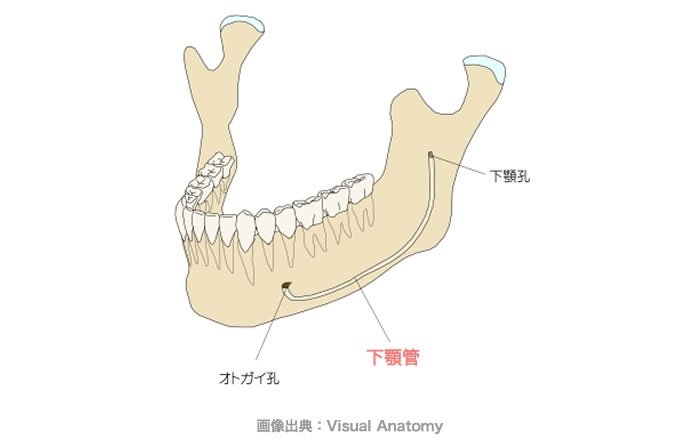インプラントの傾斜埋入が選ばれるケース：下顎の神経までの距離が近い場合