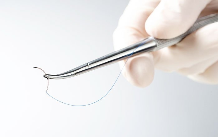 インプラント手術後数日から1週間以内に起こりやすいトラブル：縫合糸の緩み