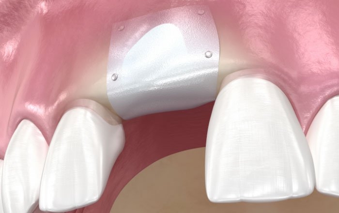 ソケットプリザベーションとは