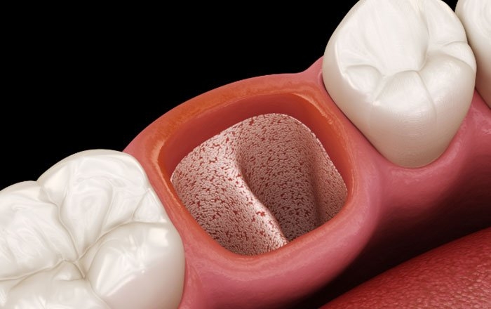 ソケットプリザベーションの方法