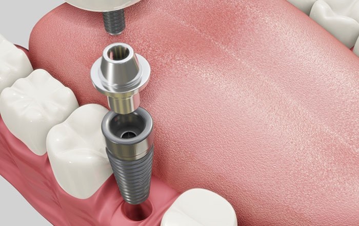 ソケットプリザベーションのメリット：インプラント治療の成功率を高める