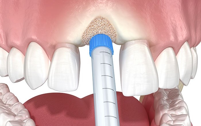 骨の減少を予防する『ソケットプリザベーション』とは