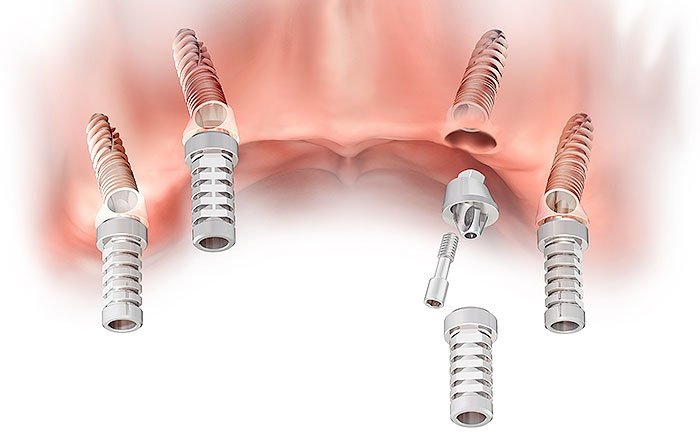 インプラントの傾斜埋入とは？