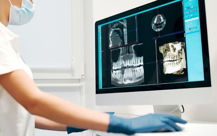 インプラントの傾斜埋入が選ばれるケース：全体的に骨の量が不足している場合