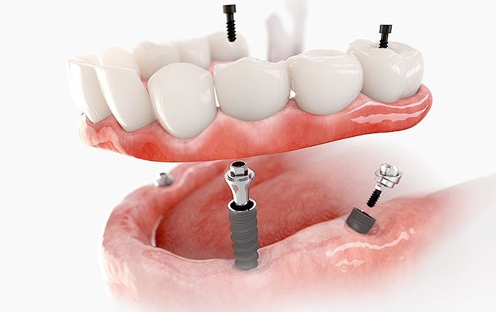 インプラントの傾斜埋入の難点：治療の難易度が高く、どの歯科医院でも受けられるものではない