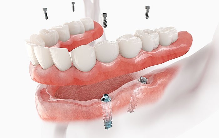 骨の量が足りなくても大丈夫！インプラントの傾斜埋入について