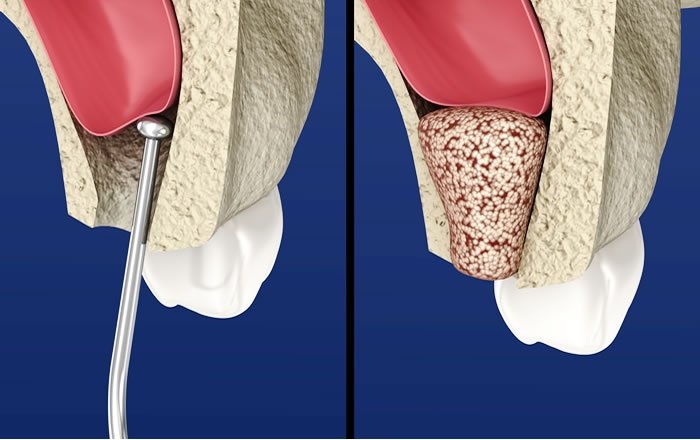 上顎洞挙上術とは、ソケットリフトやサイナスリフトなど、上顎の骨が薄くてインプラントを埋め込めない場合に、骨を補う材料を入れて厚みを増す手術のこと