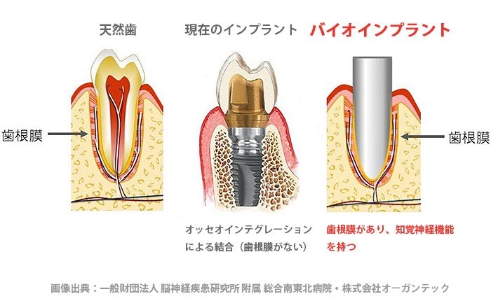 バイオインプラントとは